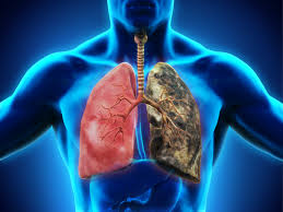 Lung disease/cancer